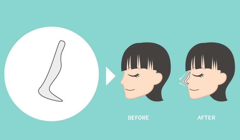 เสริมซิลิโคนจมูก