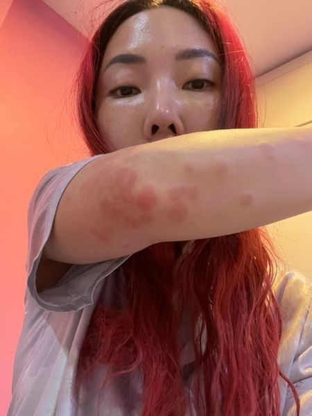 แพ้วัคซีนซิโนแวค