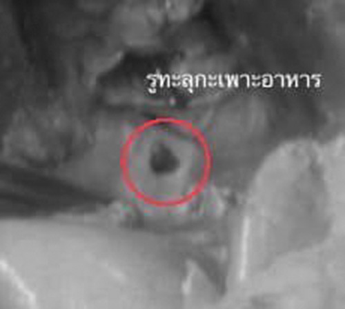 ติดโควิดกระเพาะทะลุ