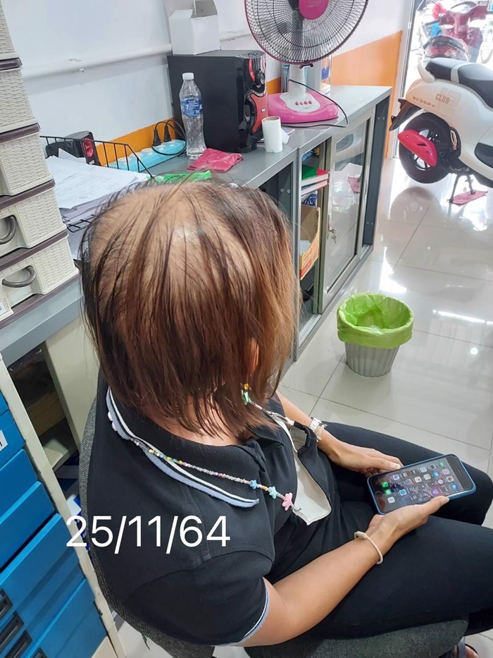 ผมร่วง