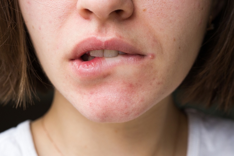 สิวขึ้นมุมปาก