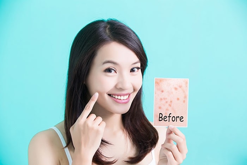 วิธีรักษาสิว