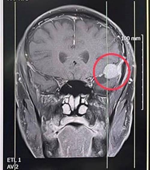 หนุ่มปวดหัว 1 ปี พบเนื้องอกในสมอง