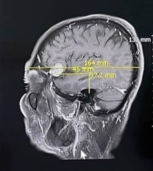 หนุ่มปวดหัว 1 ปี พบเนื้องอกในสมอง