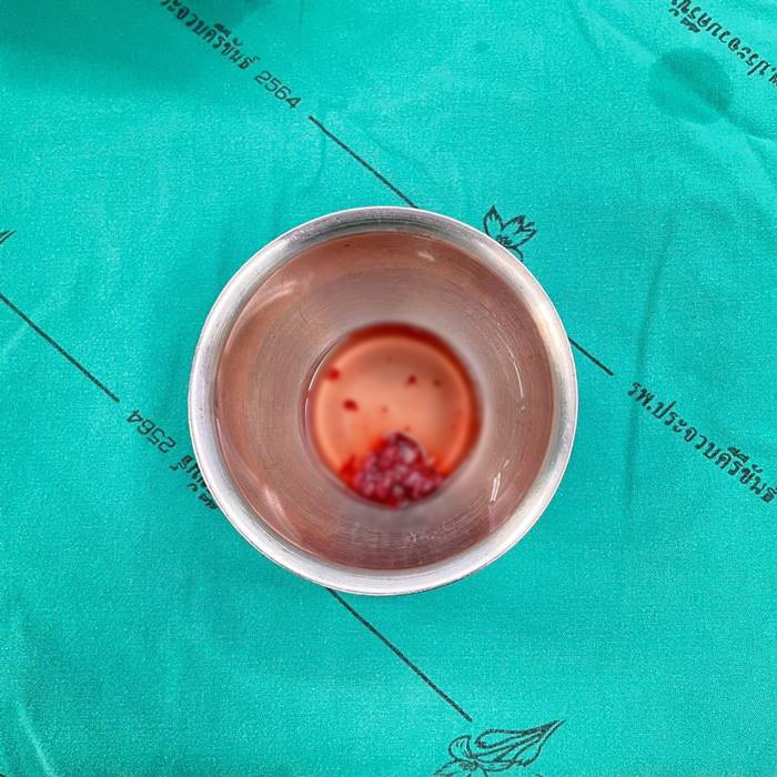 หนุ่มปวดหัว 1 ปี พบเนื้องอกในสมอง