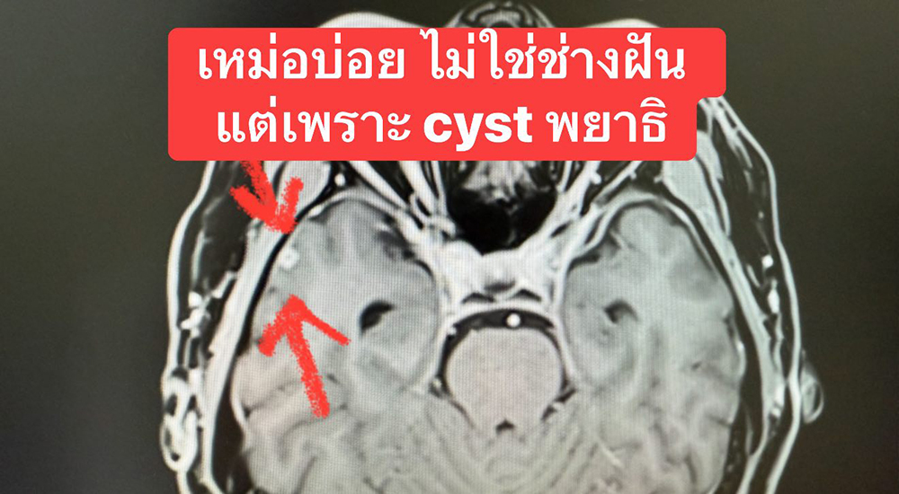 เหม่อบ่อย อาจไม่ไช่ช่างฝัน หมอชี้เพราะพยาธิ