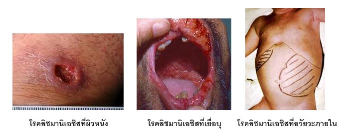 โรคลิชมาเนีย อาการ