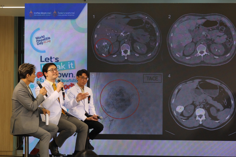 วัคซีนไวรัสตับอักเสบบี