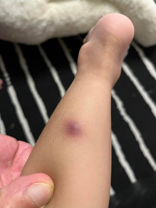 วัณโรคเทียม