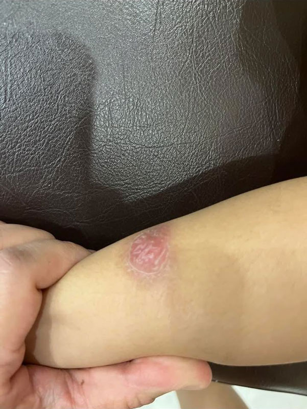 วัณโรคเทียม