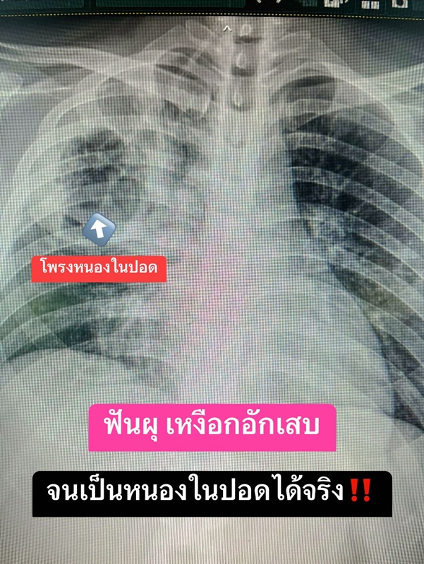 ฟันผุ เหงือกอักเสบ สามารถทำให้ปอดเป็นหนอง