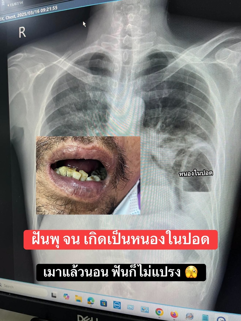 ไม่แปรงฟัน