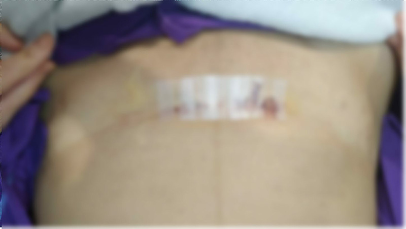 ซีสต์รังไข่