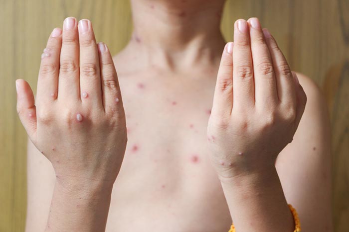 อีสุกอีใส