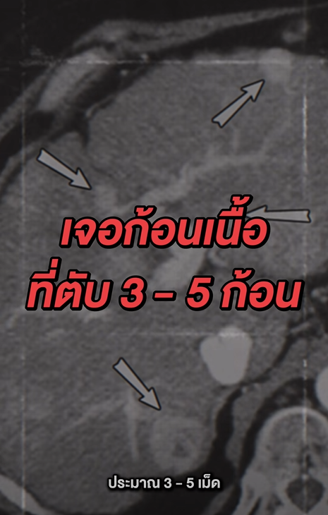 ท้องอืดบ่อยเกือบปี  สัญญาณที่มองข้าม