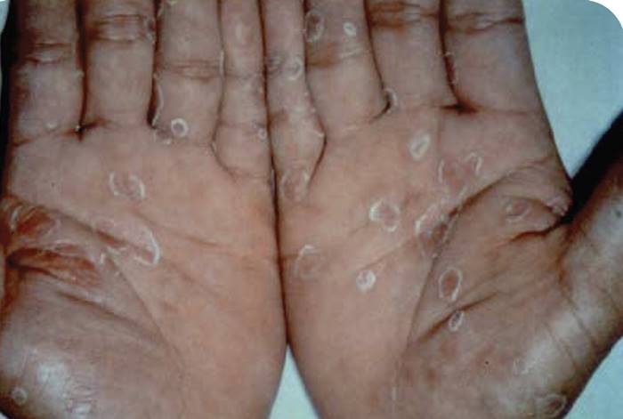 ซิฟิลิสวัยรุ่นไทยพุ่ง