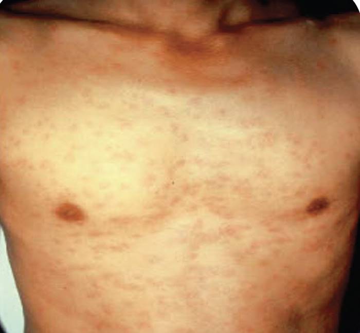 ซิฟิลิสวัยรุ่นไทยพุ่ง