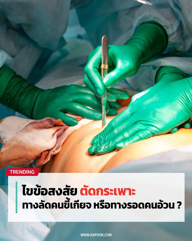 ตัดกระเพาะ