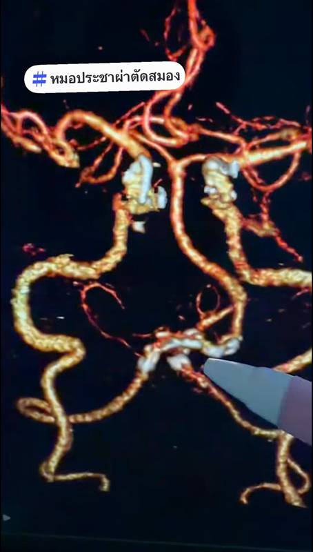 อาการ เวียนหัว