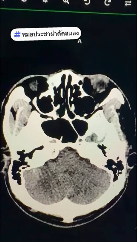 อาการ เวียนหัว