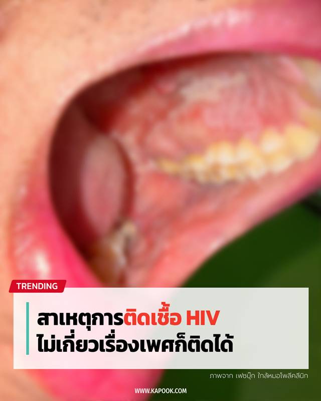 ติดเชื้อ HIV