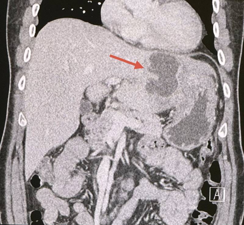 ฝีในตับ