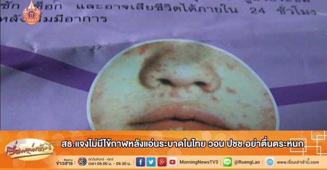 ไข้กาฬหลังแอ่น