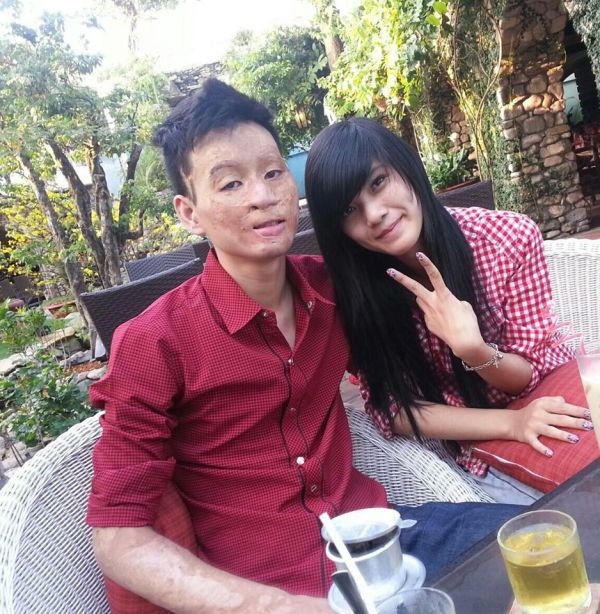 สาวเวียดนามแต่งงานกับหนุ่มเสียโฉม