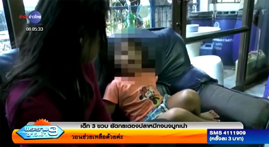 เด็ก 3 ขวบ อยากดั้งโด่ง เอากระดองปลาหมึกยัดจมูก หวิดเน่า
