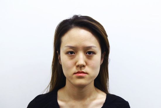 ฝาแฝดเกาหลีศัลยกรรม