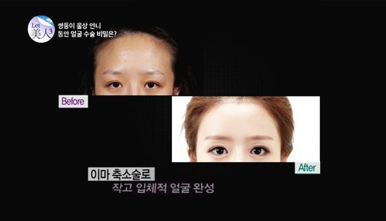 ฝาแฝดเกาหลีศัลยกรรม