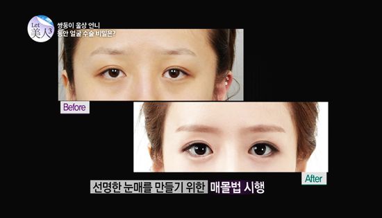 ฝาแฝดเกาหลีศัลยกรรม