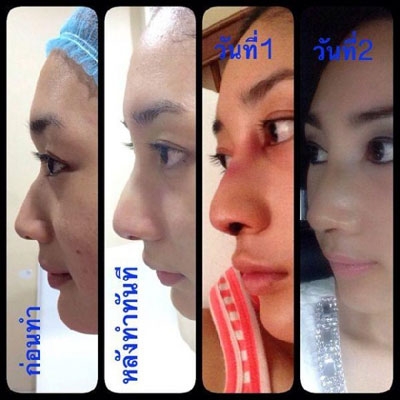 น้ำเพชร ศัลยกรรมจมูก