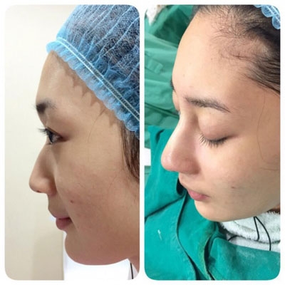 น้ำเพชร ศัลยกรรมจมูก