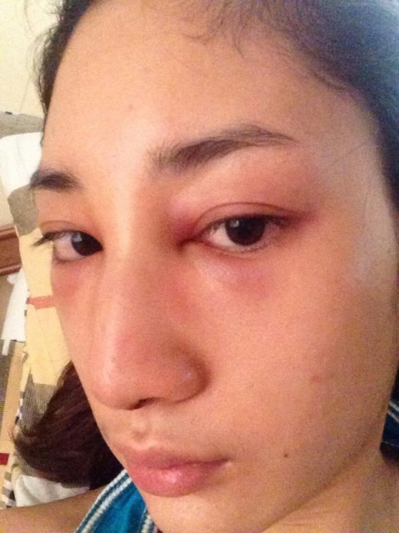 น้ำเพชร ศัลยกรรมจมูก