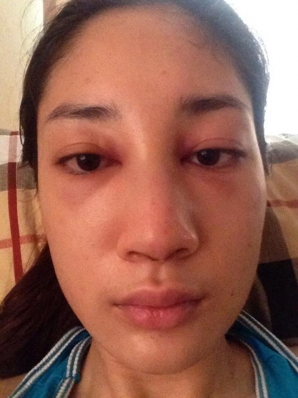 น้ำเพชร ศัลยกรรมจมูก