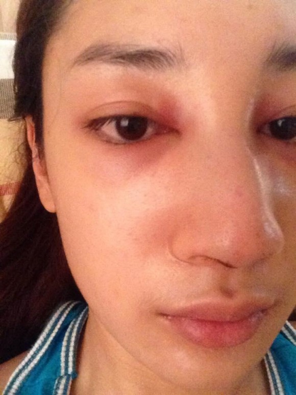 น้ำเพชร ศัลยกรรมจมูก