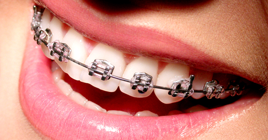 ฟันเหล็ก