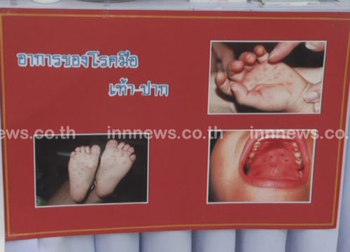 รอผลตรวจเด็ก 2 ขวบ ชี้ชัดโรคมือเท้าปาก วันนี้