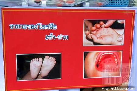 มือ เท้า ปาก