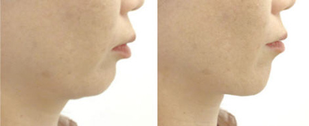 Kuwaete Sukkiri Tongue Exerciser