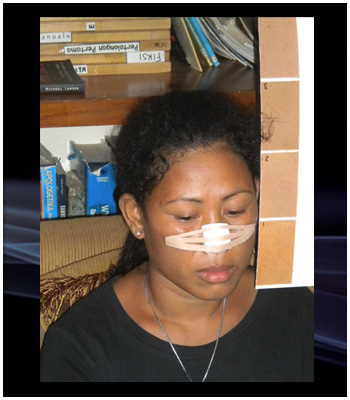 ศัลยกรรมจมูก