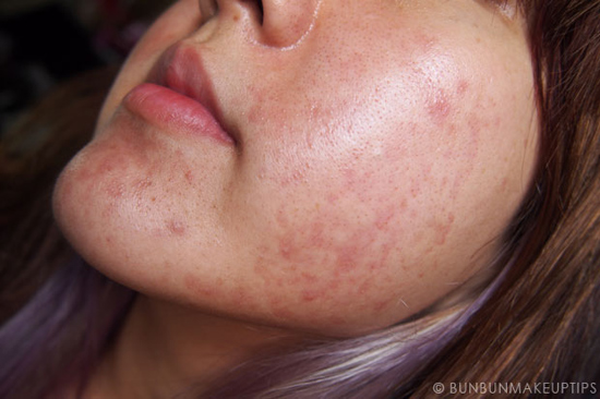 วิธีรักษาสิว