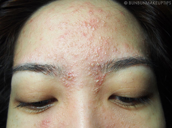 วิธีรักษาสิว