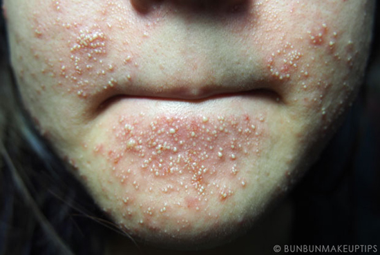 วิธีรักษาสิว