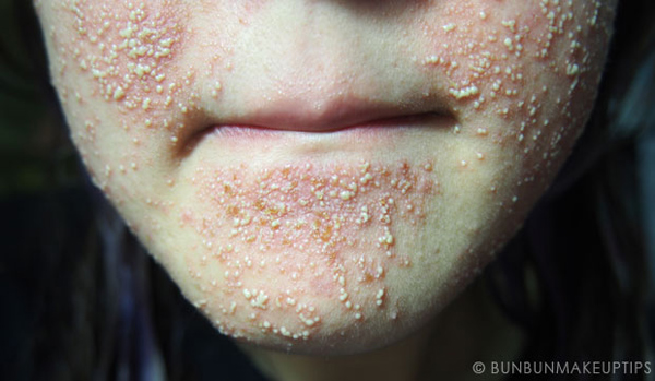 วิธีรักษาสิว