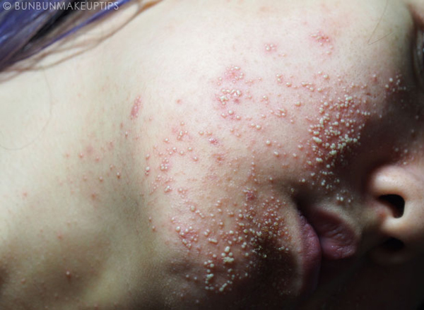 วิธีรักษาสิว