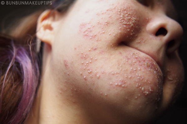 วิธีรักษาสิว