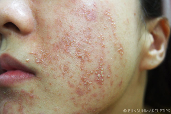 วิธีรักษาสิว