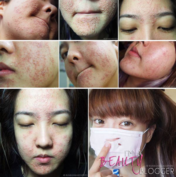 วิธีรักษาสิว